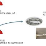3D Printed Elastomer Aids Rotator Cuff Recovery