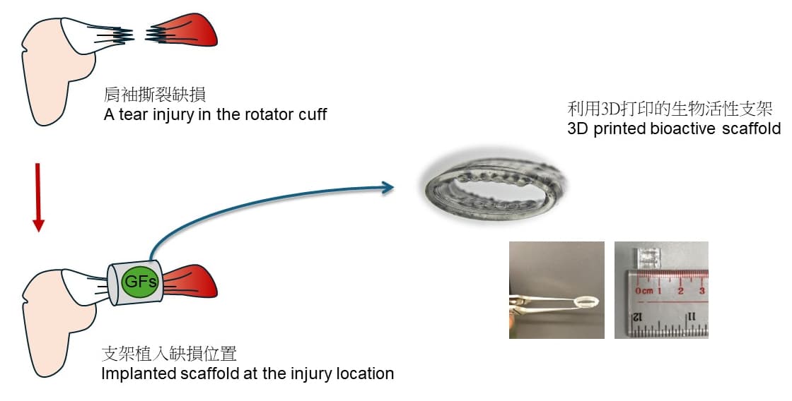 3D Printed Elastomer Aids Rotator Cuff Recovery