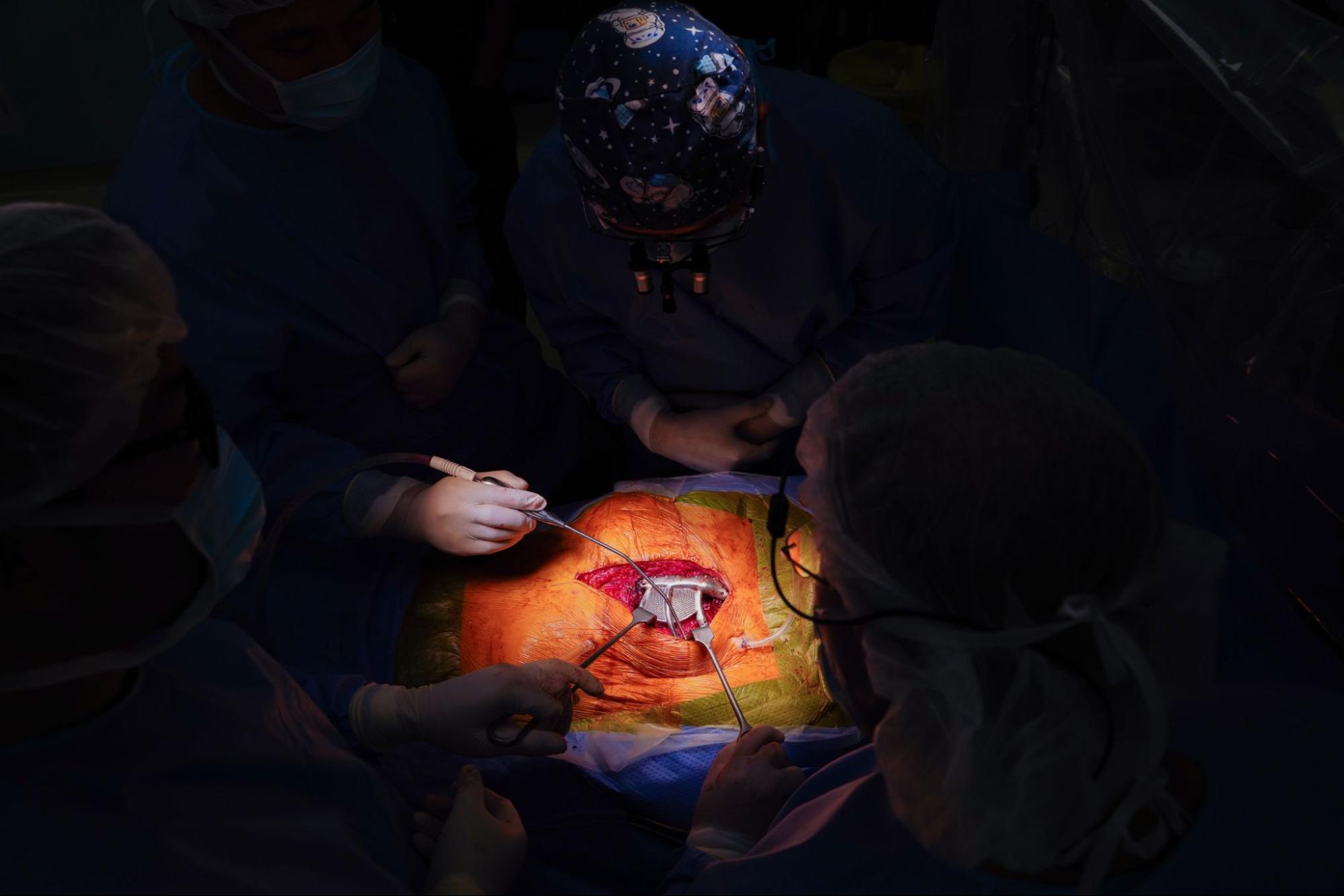 chest wall implant