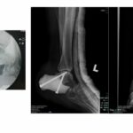 Malaysian Hospital Performs Heel Bone Replacement with 3D Printing