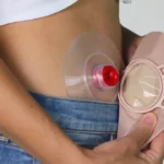 3D-Printed Intelligent Ostomy Bags Enhance Stoma Care and Patient Comfort