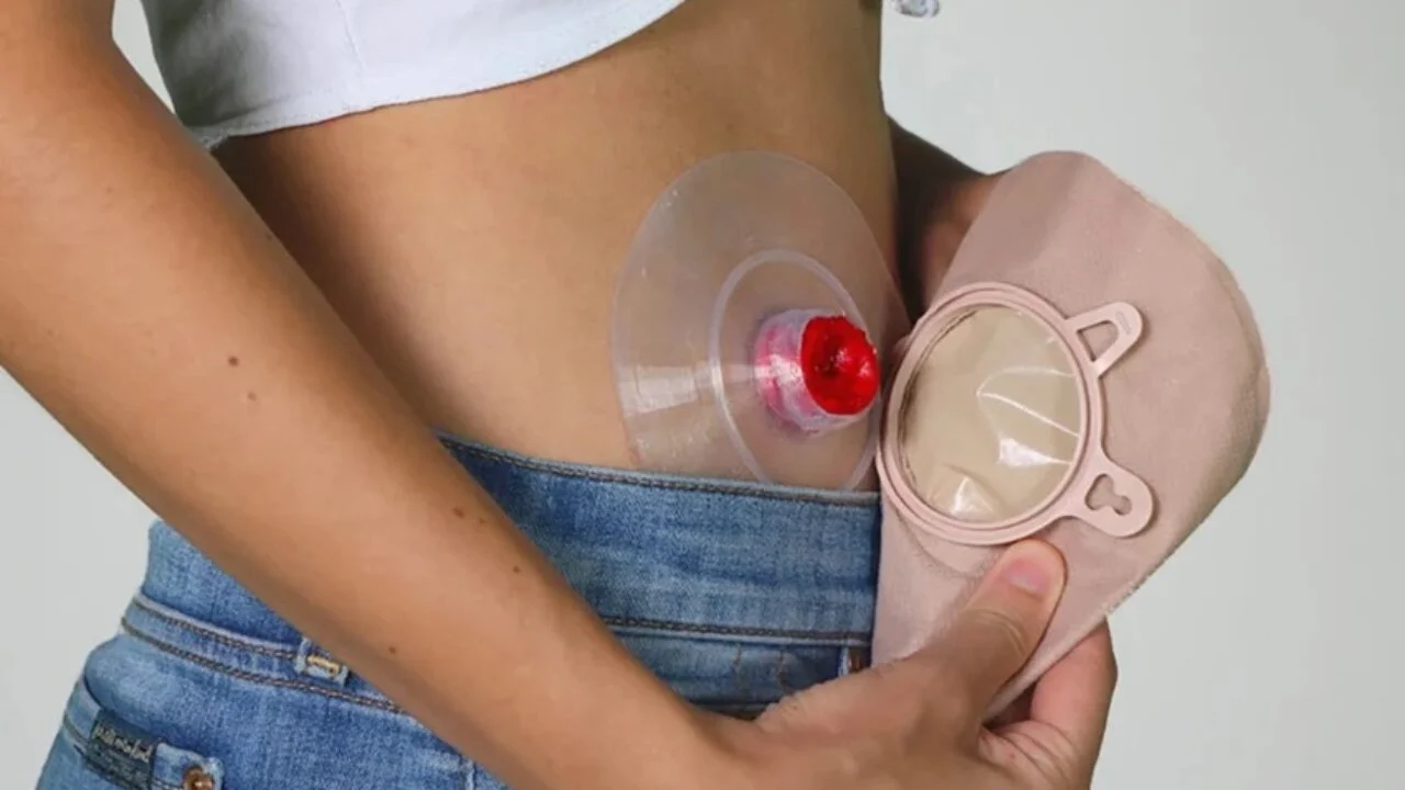 3D-Printed Intelligent Ostomy Bags Enhance Stoma Care and Patient Comfort